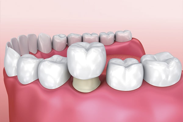 اندوکراوان دندان