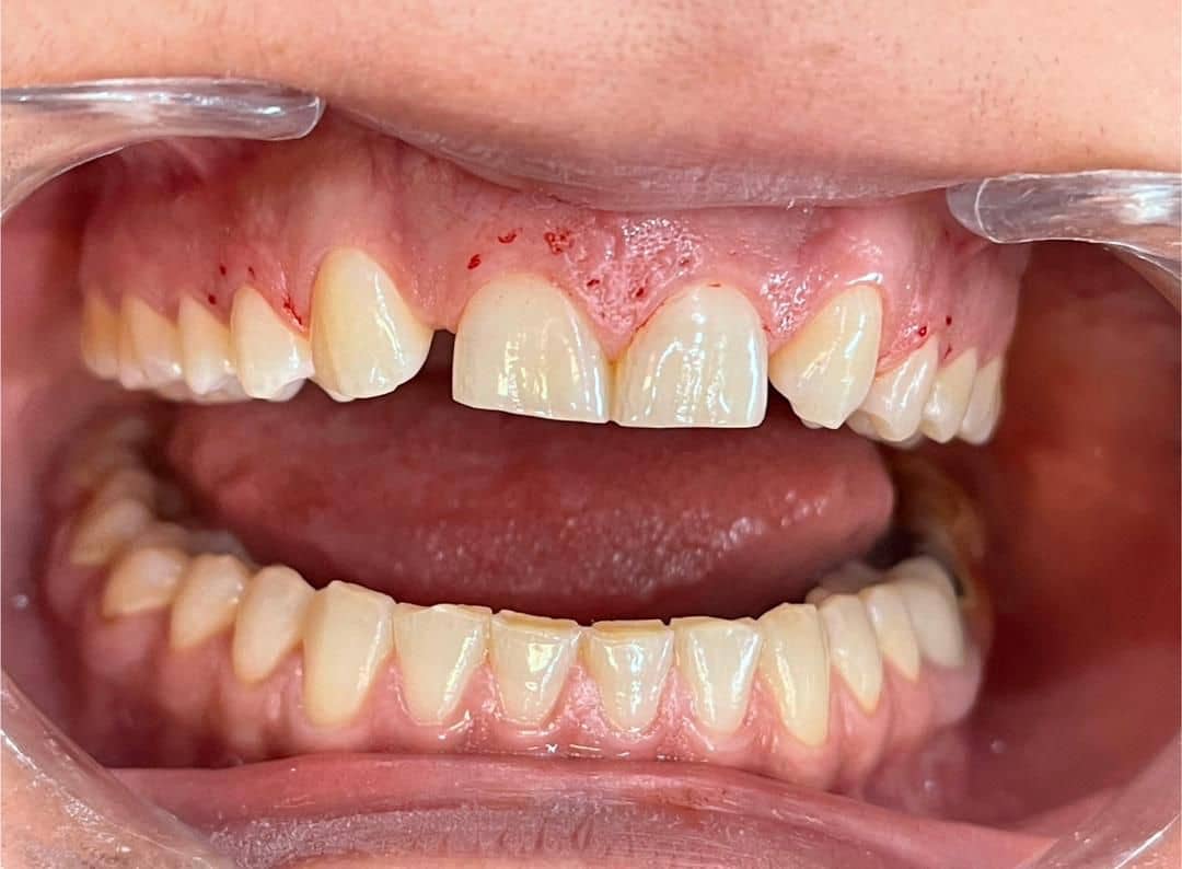 نمونه کار دندان